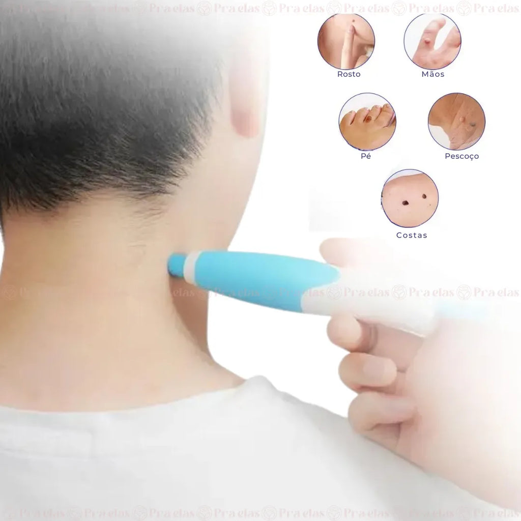 DermoPen TR-36™ | Kit Profissional para Remoção de Verrugas e Sinais