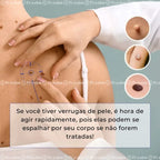 DermoPen TR-36™ | Kit Profissional para Remoção de Verrugas e Sinais