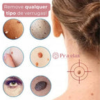 DermoPen TR-36™ | Kit Profissional para Remoção de Verrugas e Sinais